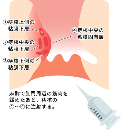 ALTA療法（ジオン注）