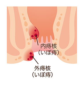内痔核