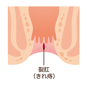 切れ痔