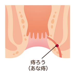 痔ろう