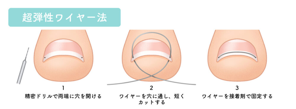 治療の流れ