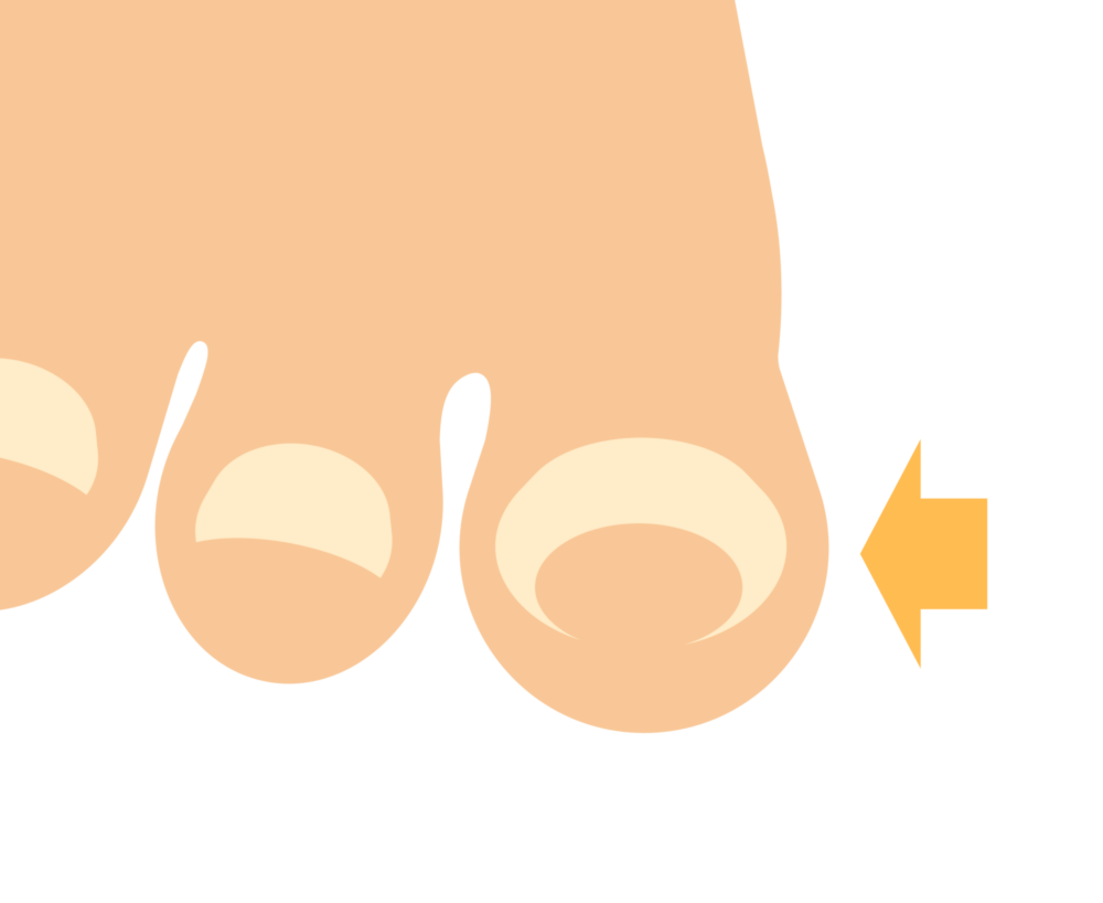 巻き爪
